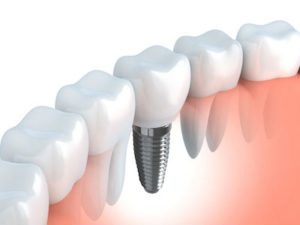 Rendering of how dental implants fit in the jaw between original teeth. 